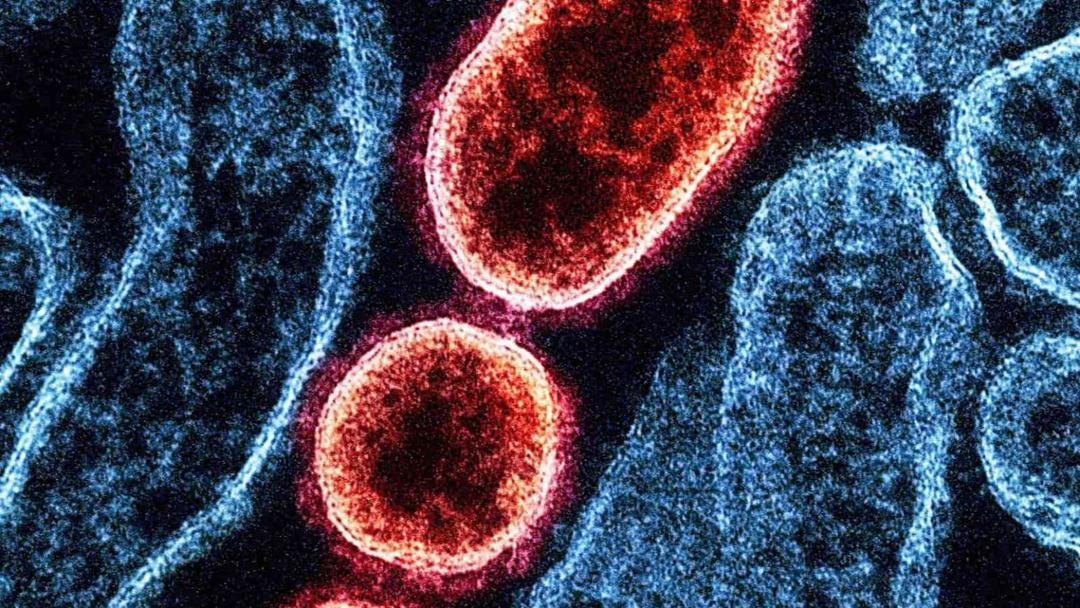 Nipah Virus Kills Teenager in India