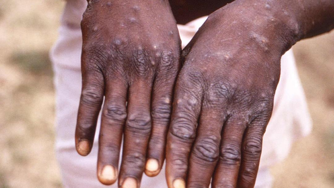 WHO Declares Mpox Outbreak a Global Health Emergency