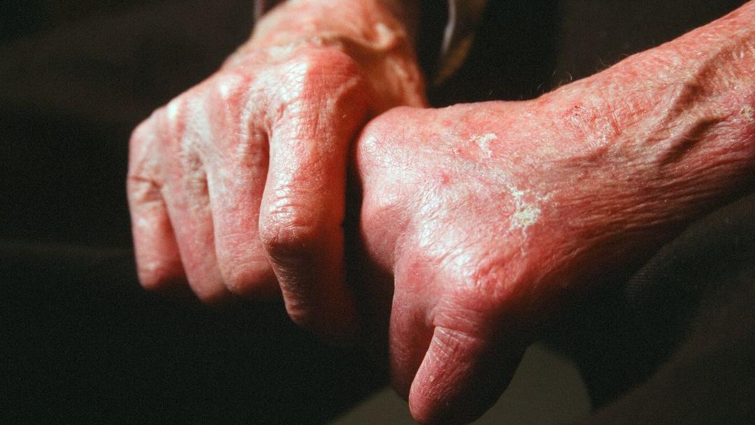 Study: Ancient DNA Reveals Pre-Columbian Leprosy in Americas