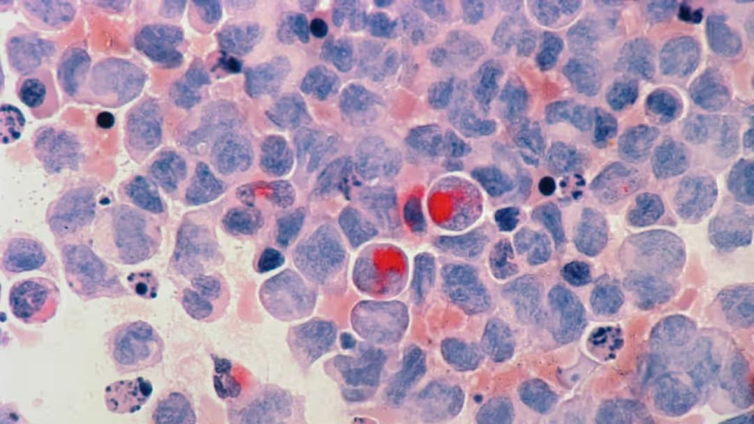 UK: NHS Pilots 'Sponge on String' Cancer Test in Pharmacies