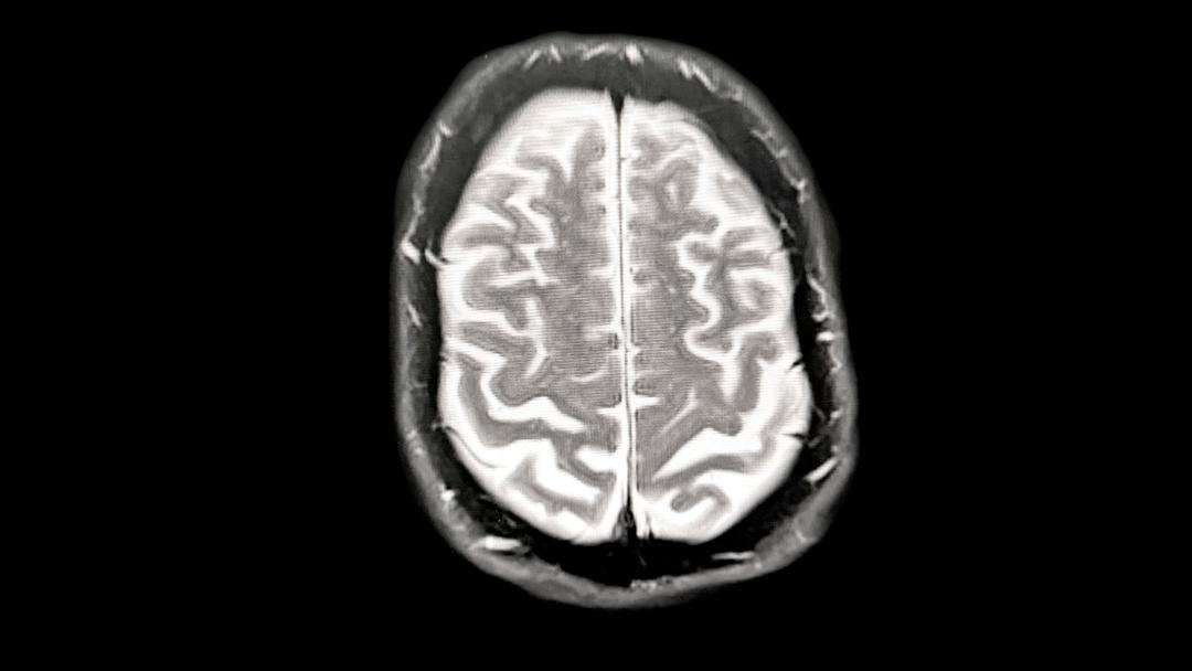 Protein Study Reveals New Alzheimer's Clues, Breast Cancer Link