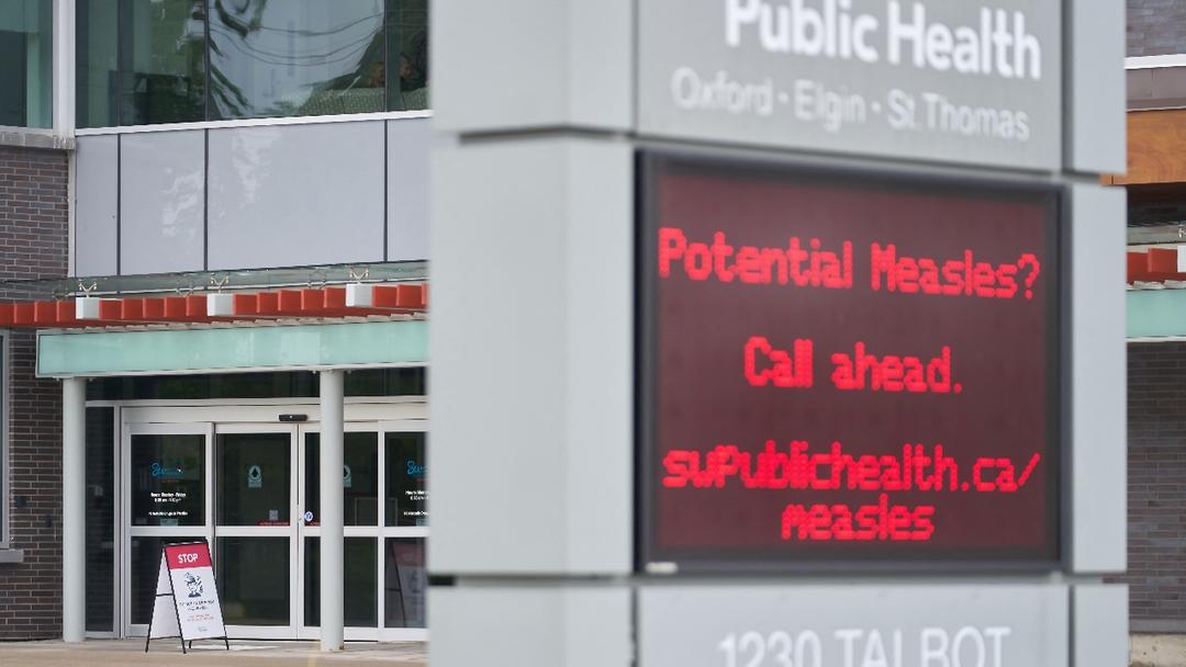 Canada Loses Measles-Free Status After 27 Years